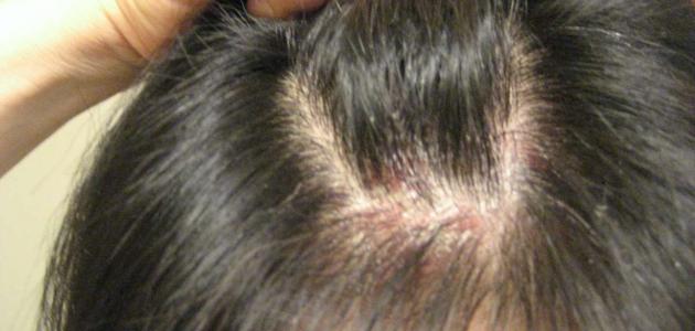 اسباب علاج حساسية فروة الرأس